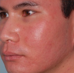 25-34 year old man treated with Acne Scars Treatment after 2465698