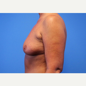 55-64 year old woman treated with Breast Implants before 3439982