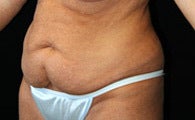 Tummy Tuck before 1158101