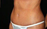 Tummy Tuck after 1158101