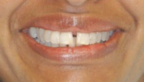 Adult Orthodontics with Six Month Smiles before 3660017
