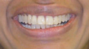 Adult Orthodontics with Six Month Smiles after 3660017