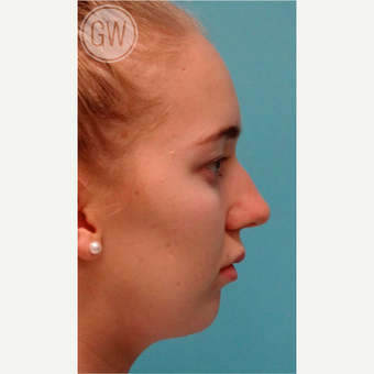 18-24 year old woman treated with a sliding genioplasty before 3473447