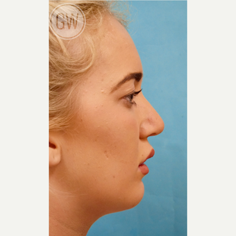 18-24 year old woman treated with a sliding genioplasty after 3473447