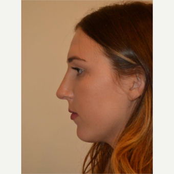 18-24 year old woman treated with Rhinoplasty after 3657952