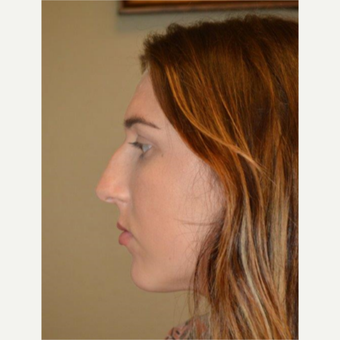 18-24 year old woman treated with Rhinoplasty before 3657952