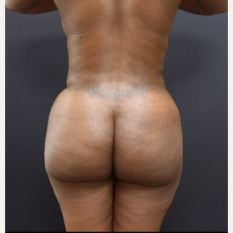 35-44 year old woman treated with Brazilian Butt Lift after 3200888