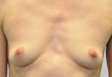 Structured Ideal Implant before 3321351