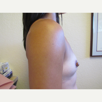 35-44 year old woman treated with Breast Implants before 3411994