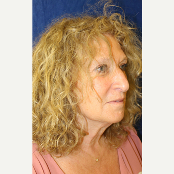 45-54 year old woman treated with Facelift before 3741758