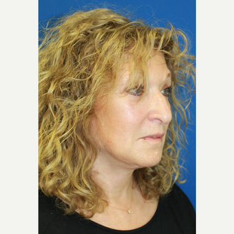 45-54 year old woman treated with Facelift after 3741758