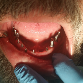 55-64 year old man treated with All-on-4 Dental Implants before 2376584