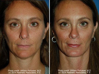 Neck Liposuction before 1389720