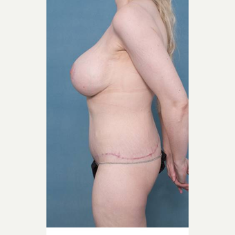 25-34 year old woman treated with Body Lift after 3421131