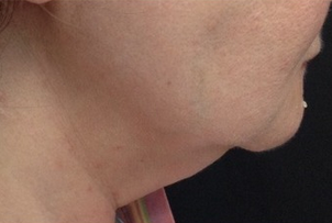 Woman treated with Pelleve before 2112701