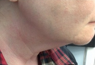 Woman treated with Pelleve after 2112701