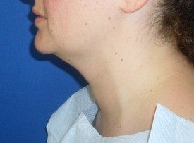 Laser Liposuction before 561212