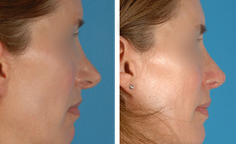 Revision Rhinoplasty before 1208289