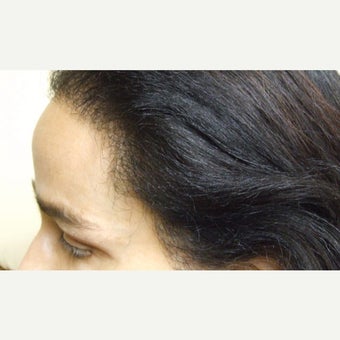 45-54 year old woman treated with Forehead Reduction with Hair Transplant after 1973882