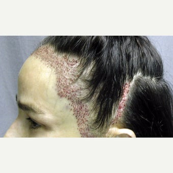 45-54 year old woman treated with Forehead Reduction with Hair Transplant before 1973882