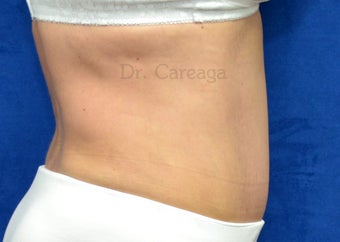 Muscle separation after 1392945