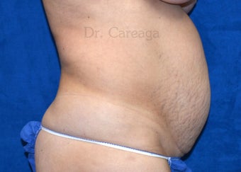 Muscle separation before 1392945