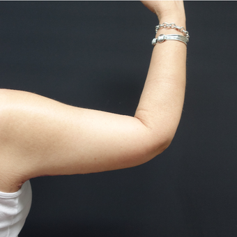 45-54 year old woman treated with Arm Lift after 3730406