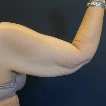 45-54 year old woman treated with Arm Lift before 3730406