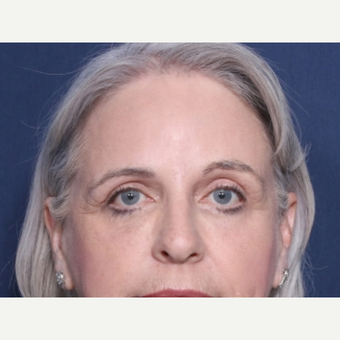 55-64 year old woman treated with Eyelid Surgery after 3180331