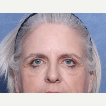 55-64 year old woman treated with Eyelid Surgery before 3180331
