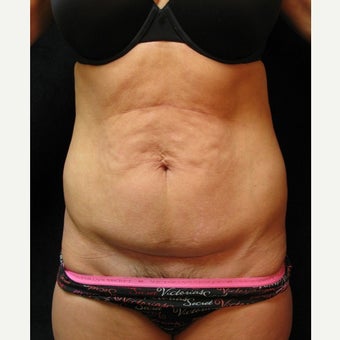 Tummy Tuck before 2410832
