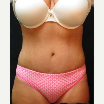 Tummy Tuck after 2410832
