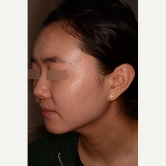 Treatment of severe nodulocystic acne; no Accutane 1826289