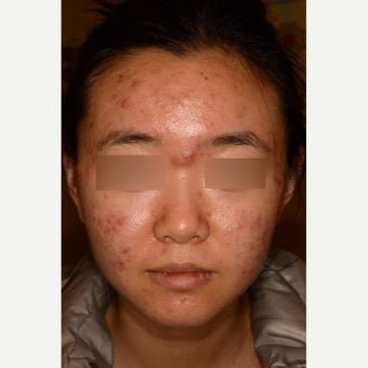 Treatment of severe nodulocystic acne; no Accutane before 1826289