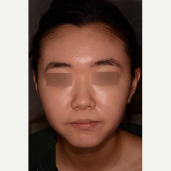Treatment of severe nodulocystic acne; no Accutane after 1826289