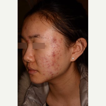 Treatment of severe nodulocystic acne; no Accutane 1826289