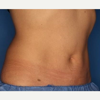 25-34 year old woman treated with CoolSculpting after 3711330