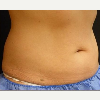 25-34 year old woman treated with CoolSculpting before 3711330