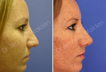 Septorhinoplasty before 1112643