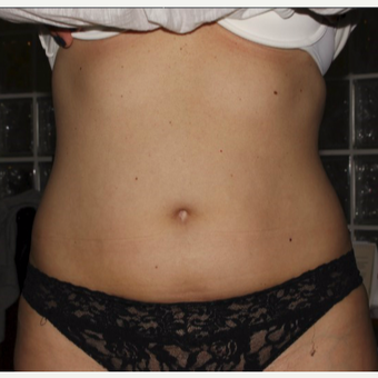 45-54 year old woman treated with Vanquish after 3725531