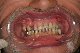 60 year old male treated with All-on-4 Dental Implant Procedure before 1053453