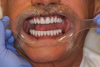 60 year old male treated with All-on-4 Dental Implant Procedure after 1053453