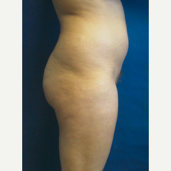 liposuction treated realself buttock