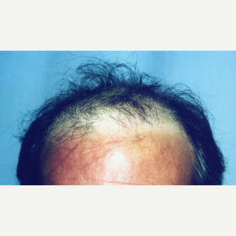 25-34 year old man treated with Hair Transplant before 3187082