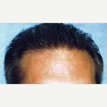 25-34 year old man treated with Hair Transplant after 3187082
