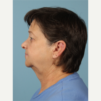 55-64 year old woman treated with Facelift before 3617706