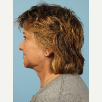 55-64 year old woman treated with Facelift after 3617706