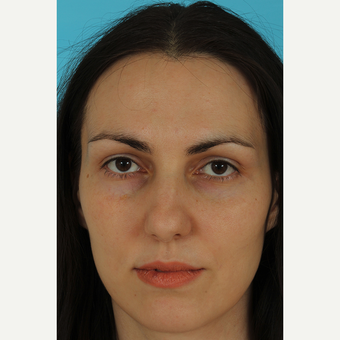 25-34 year old woman treated with Revision Rhinoplasty before 3630130