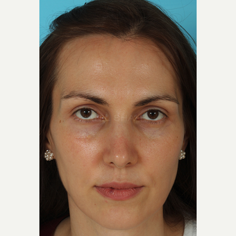 25-34 year old woman treated with Revision Rhinoplasty after 3630130