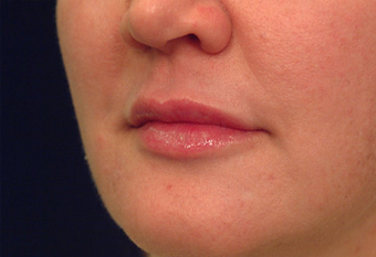 Restylane after 149882